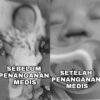 Dugaan Malapraktik RS Konawe, Bayi Usia 1 Bulan Alami Hidung Cacat