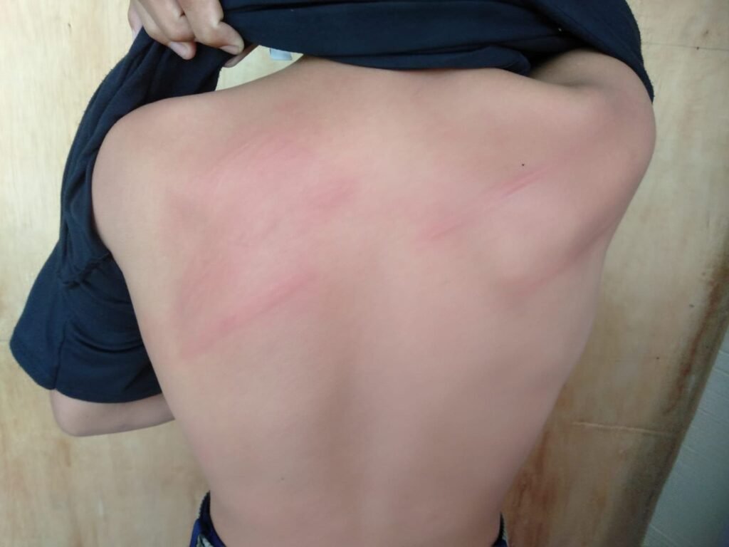 Kondisi siswa SMP di Baubau usai dianiaya gurunya.