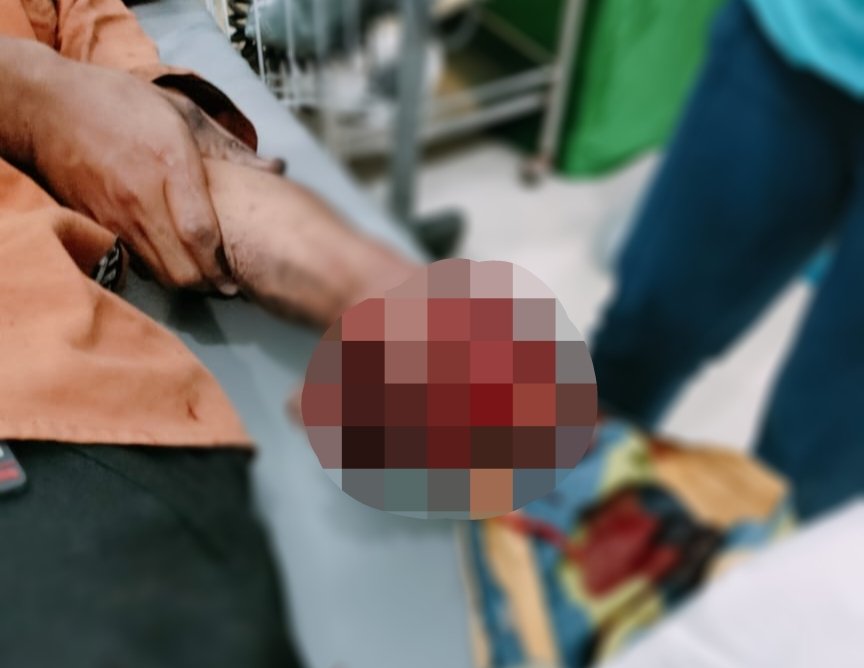 Kondisi tangan karyawan BMKG bernama Mirda Judri yang hancur usai terkena ledakan petasan rakitan di Konawe. Foto: Istimewa.