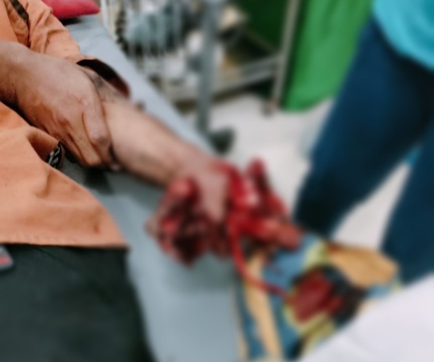 Tangan Karyawan BMKG Hancur Terkena Ledakan Petasan Rakitan di Konawe Tangan Karyawan BMKG Hancur Terkena Ledakan Petasan Rakitan di Konawe