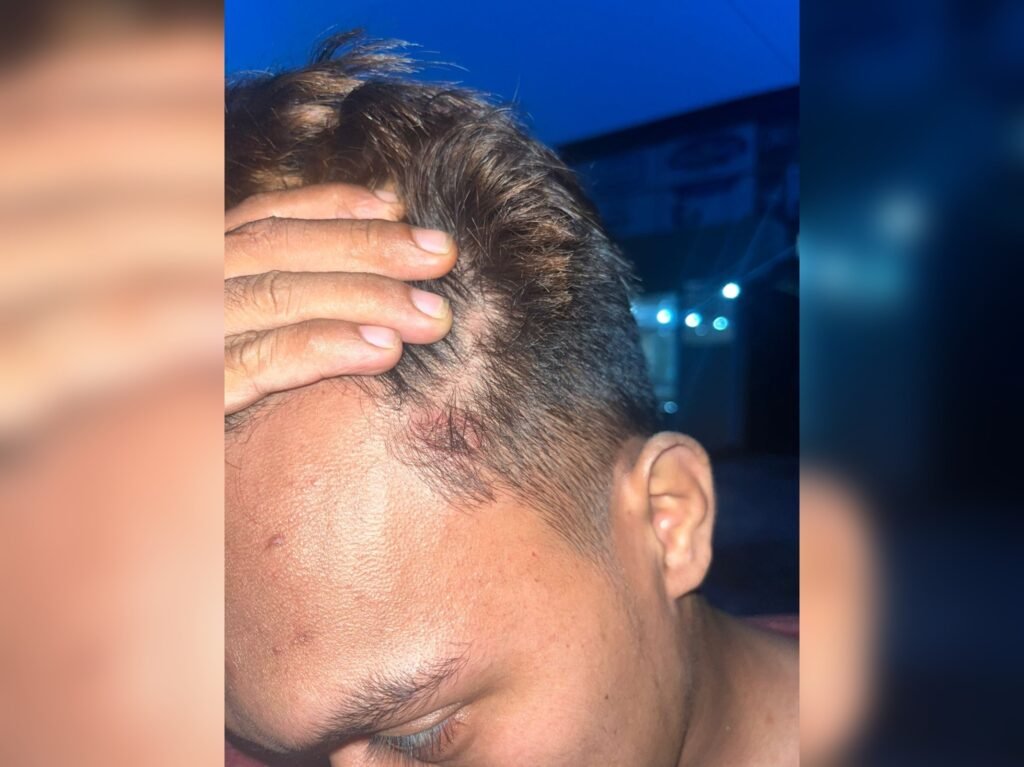 Mahasiswa berinisial W (24) mengalami luka-luka diduga dikeroyok oknum TNI berinisial AA yang bertugas di Kodim 1417/Kendari.