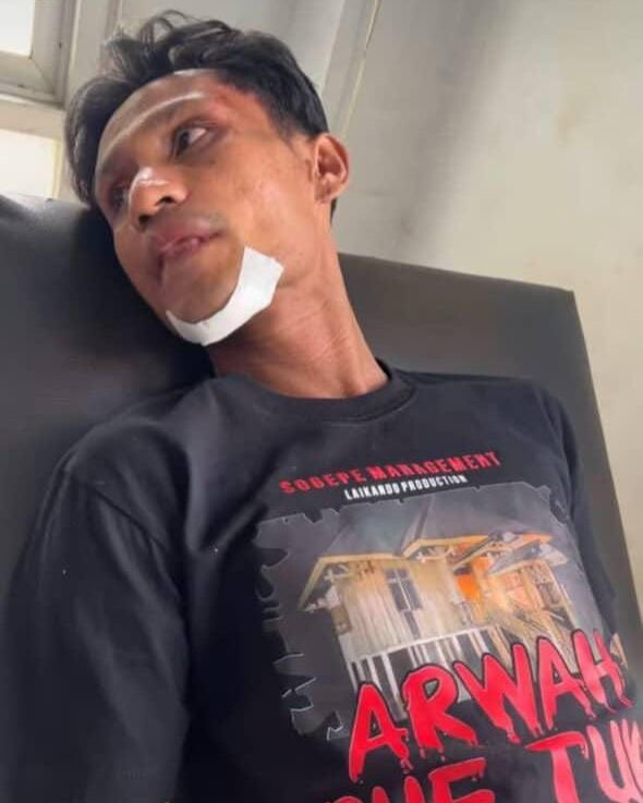 Selebgram Princess Piranha saat dilarikan ke puskesmas dan mengalami luka di wajah usai mobilnya terjun ke jurang di Desa Wawolesea, Kecamatan Wawolesea, Kabupaten Konawe Utara.