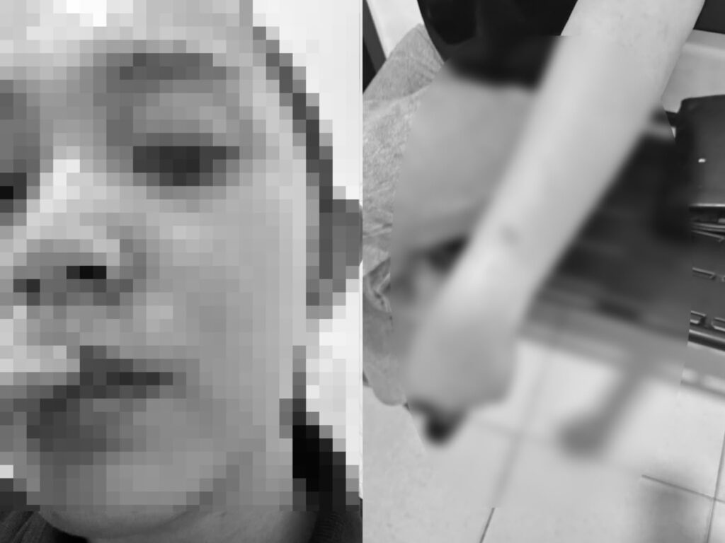 Kondisi istri asal Kota Kendari berinisial RMR (30) setelah diduga mengalami kekerasan dari oknum Brimob Polda Sultra berinisial LON, yang merupakan suaminya.